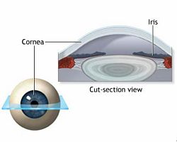 lasik procedure corrective eye surgery performed by Dr. Astorino at Newport Beach, CA Eye Center