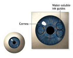 lasik procedure corrective eye surgery performed by Dr. Astorino at Newport Beach, CA Eye Center