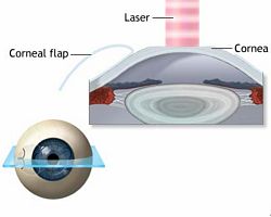 lasik procedure corrective eye surgery performed by Dr. Astorino at Newport Beach, CA Eye Center