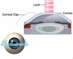 lasik procedure corrective eye surgery performed by Dr. Astorino at Newport Beach, CA Eye Center